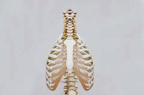 Intravenous lidocaine infusion therapy and intraoperative neurophysiological monitoring in adolescents undergoing idiopathic scoliosis correction