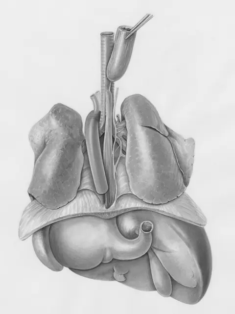Inverse ratio ventilation versus conventional ratio ventilation during one lung ventilation in neonatal open repair of esophageal atresia/tracheoesophageal fistula