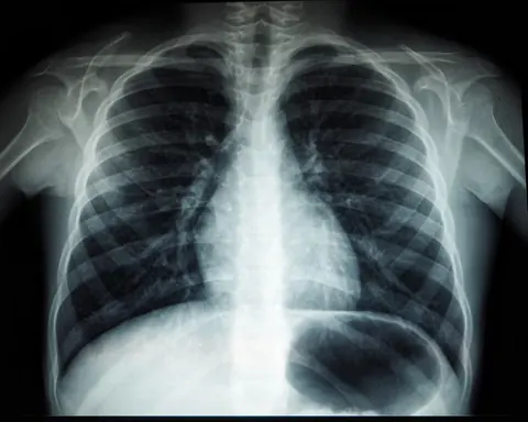 Pediatric anesthetic for tracheobronchial foreign body extraction